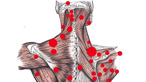 Muscle points that cause myofascial back pain