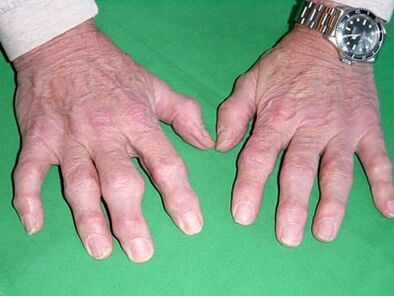 arthrosis of the fingers