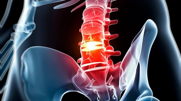 the lumbar spine osteochondrosis