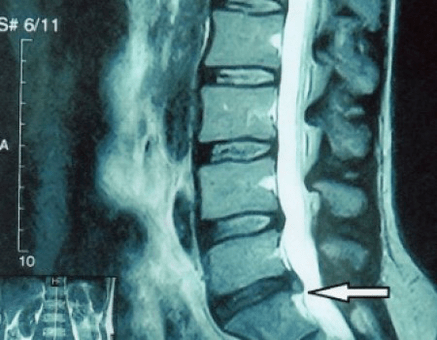 Spinal disc protrusion on MRI