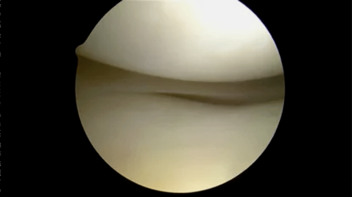 astroscope image of completely healthy surfaces