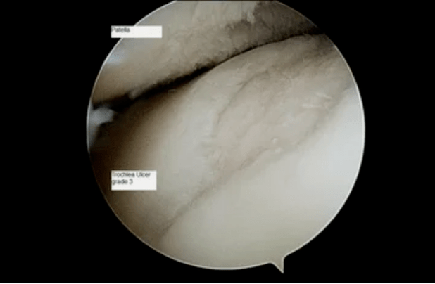 astroscope view of a knee joint with grade 3 arthrosis